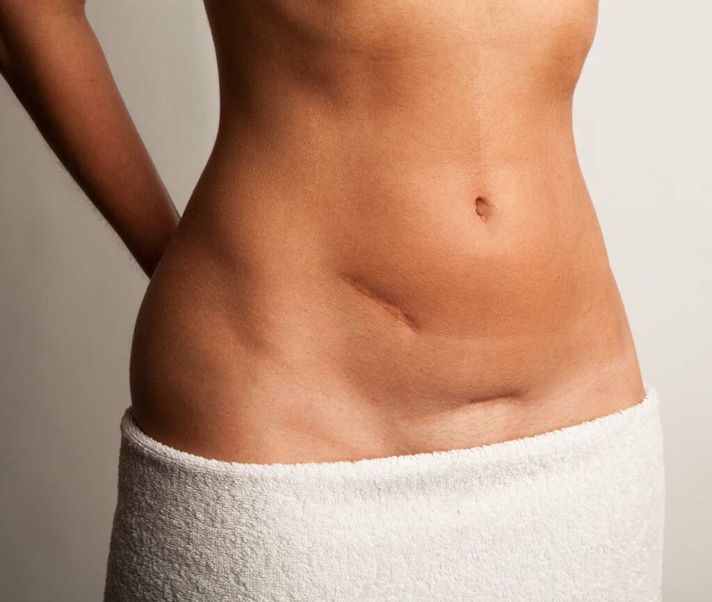 Kvinne med arr på magen